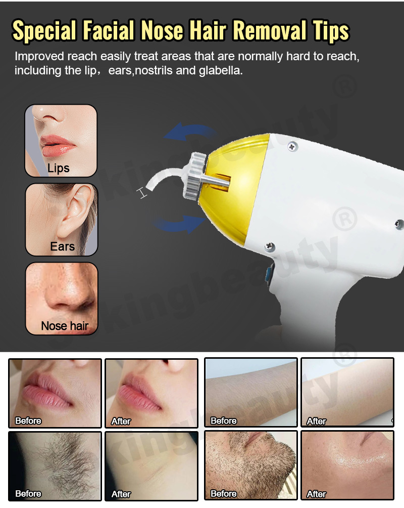 buy laser hair removal machine