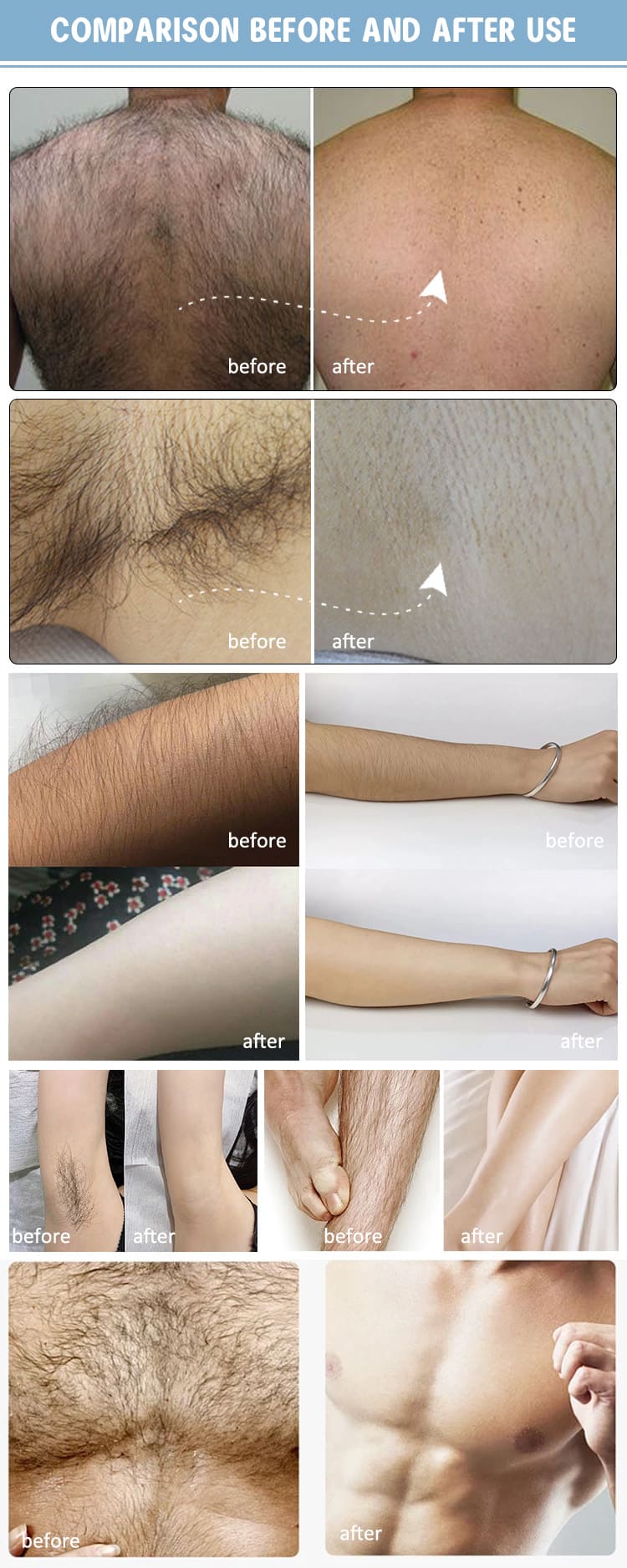 permanent hair removal price