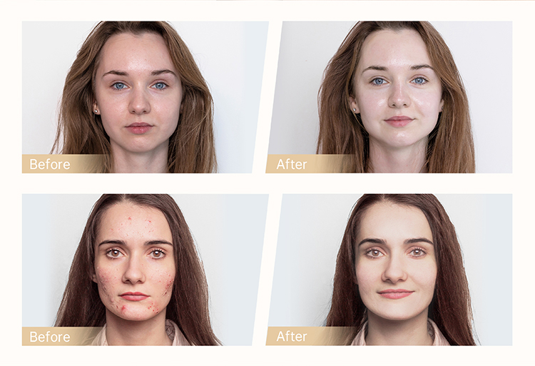 Hydra Pen facial treatment4