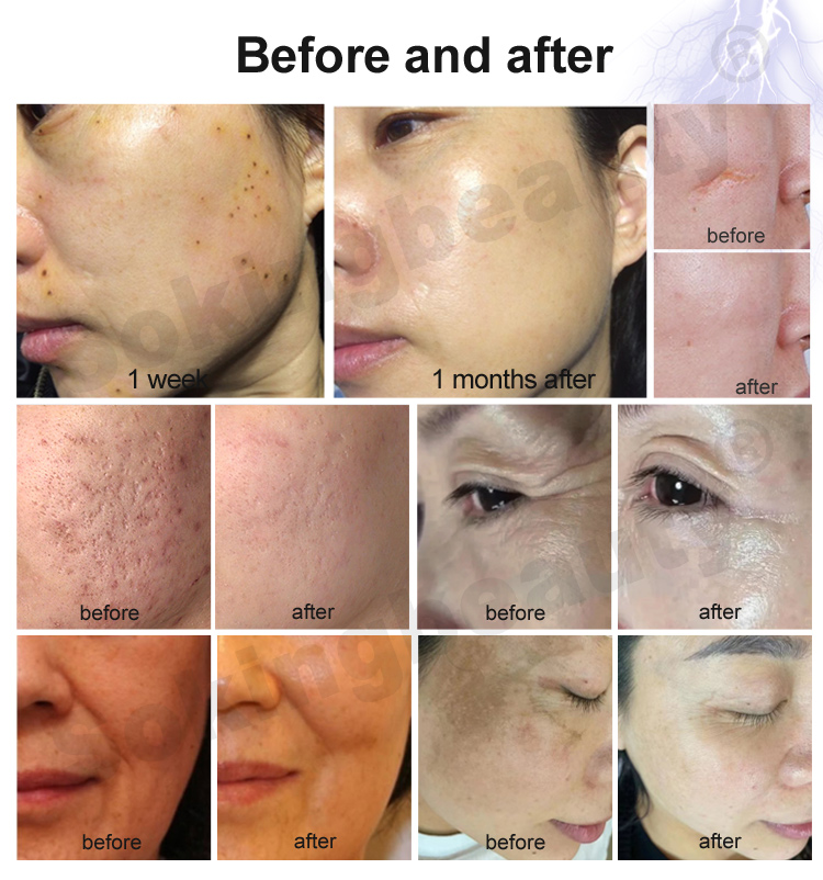 cold plasma acne device