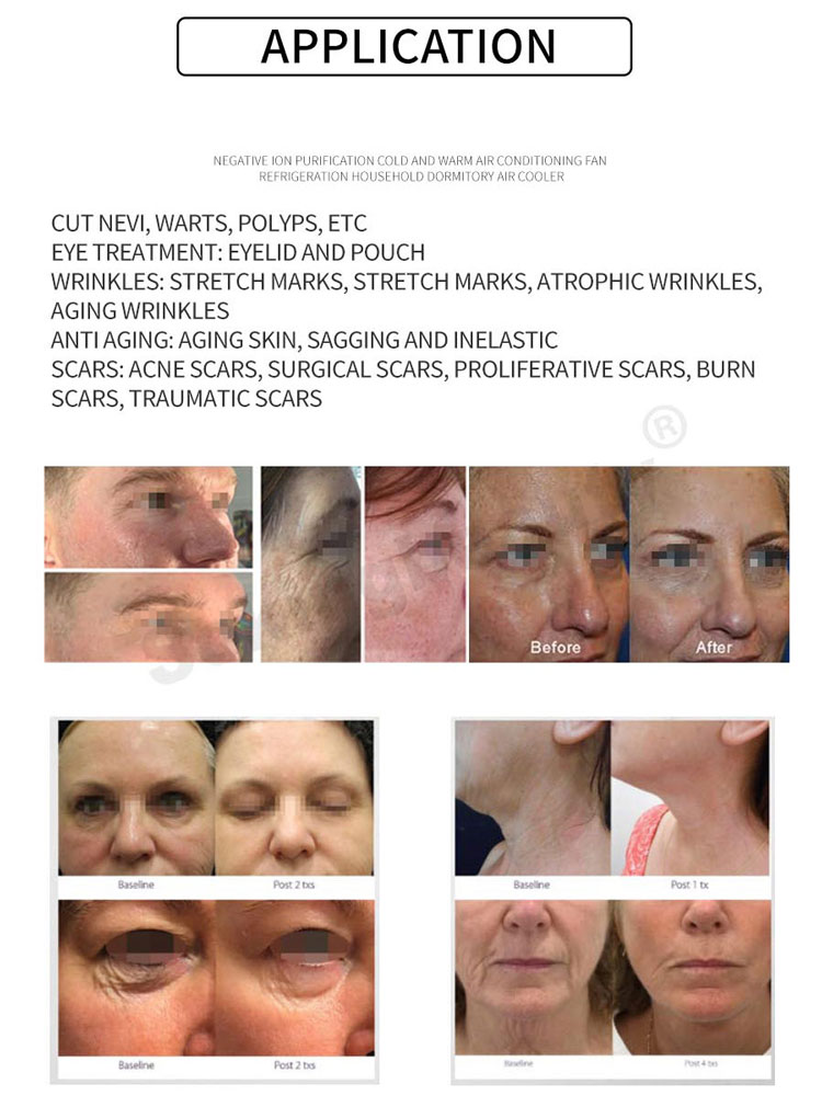 fractional plasma skin tightening