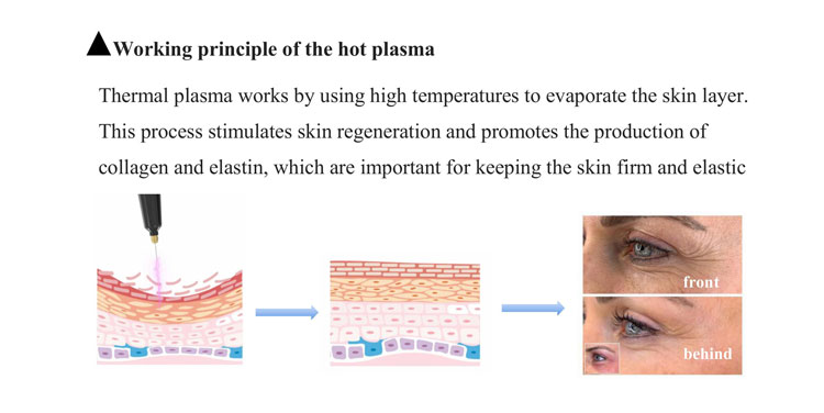 plasma skin tightening