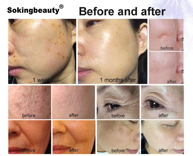 plasma fibroblast eye lift