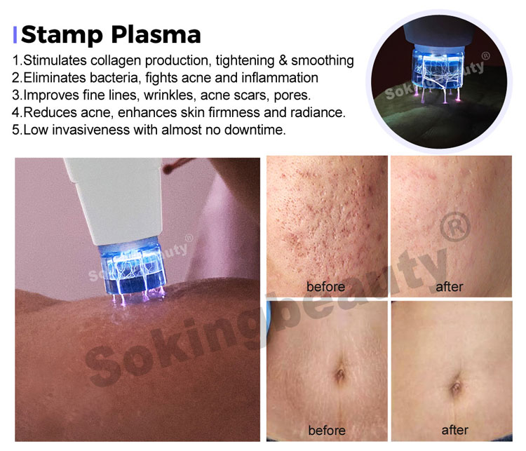 Plasma Lift Pen Machine