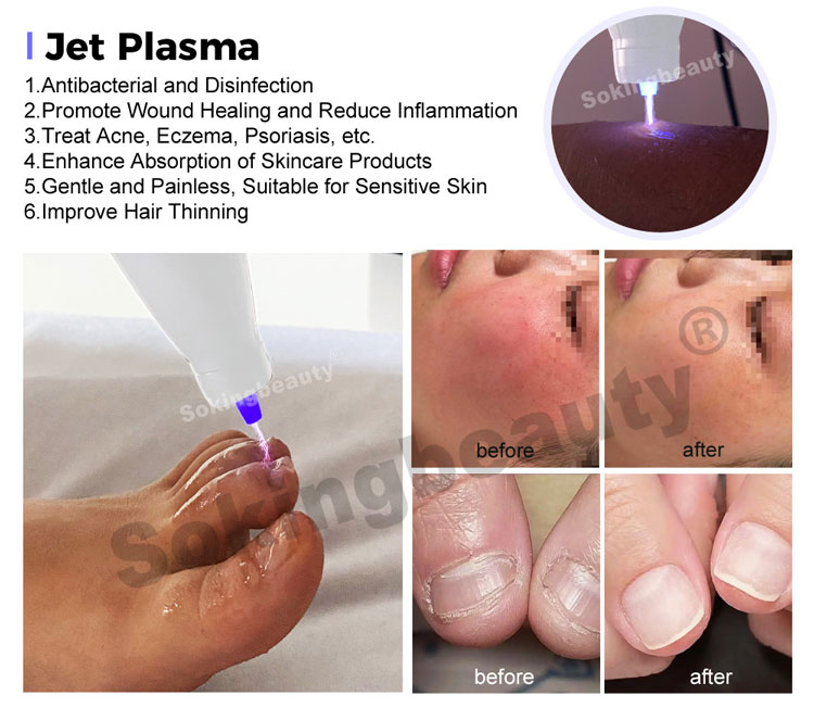 Plasma Lift Pen Machine