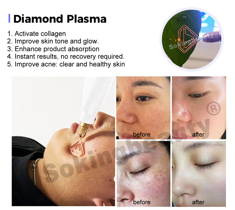 Plasma Lift Pen Machine