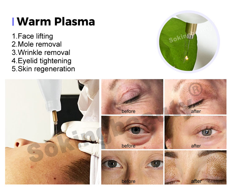 Plasma Lift Pen Machine