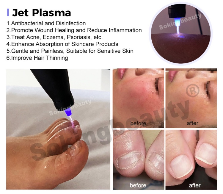 cold plasma medical device08
