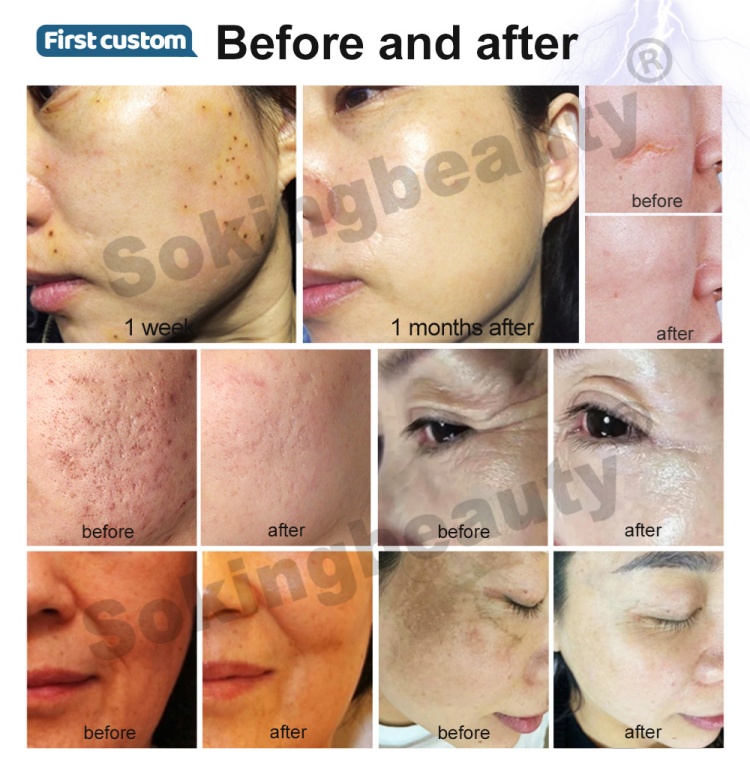 cold plasma medical device13