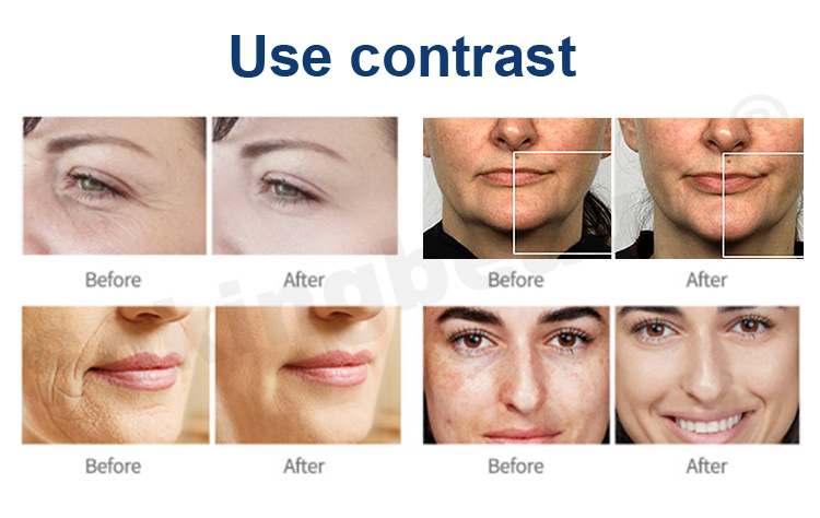 plasma pen wrinkle removal