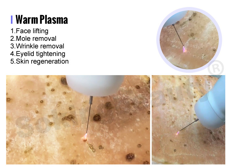 cold plasma machine