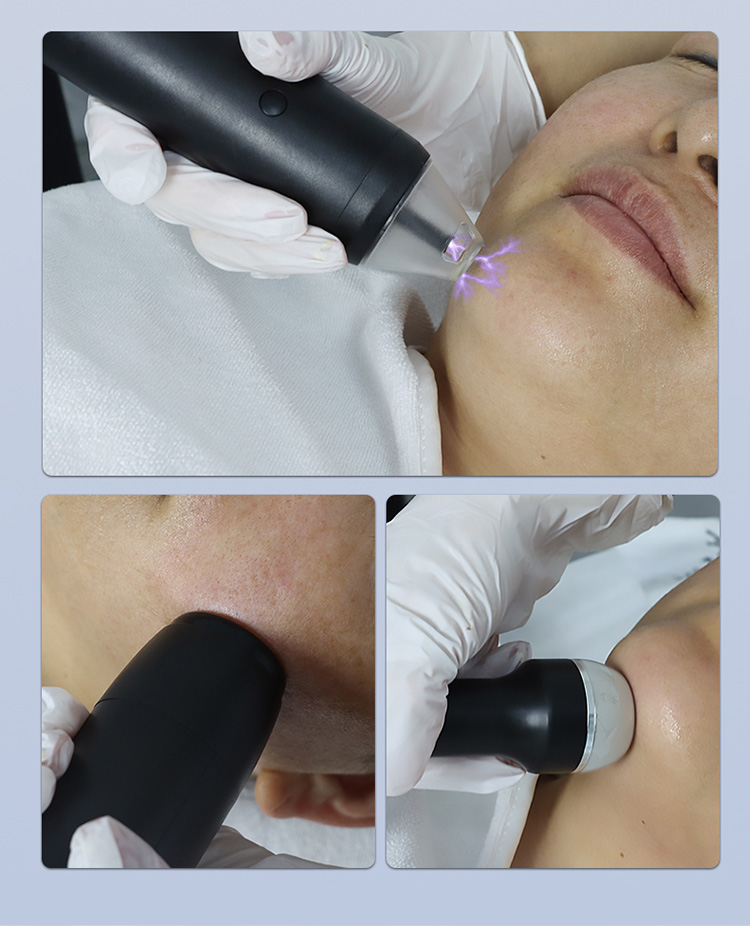 plasma anti aging device03