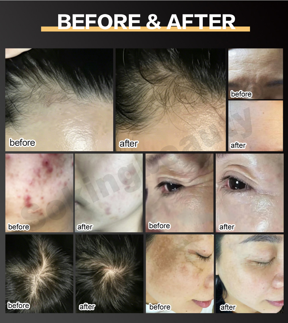 hair-growth-comb-plasma-device-11.jpg