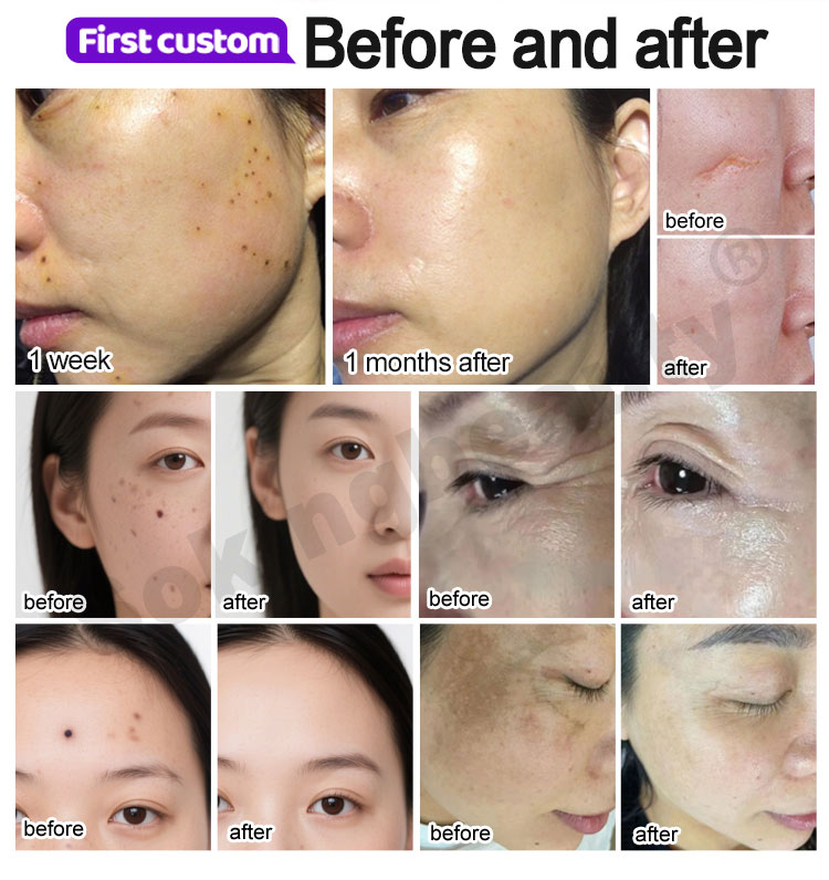 warm plasma facial device