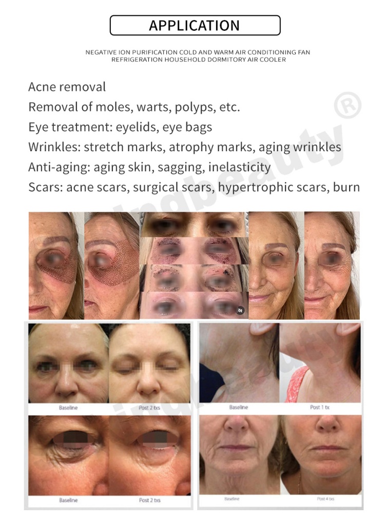 Jet Plasma Facial Treatment Pen12
